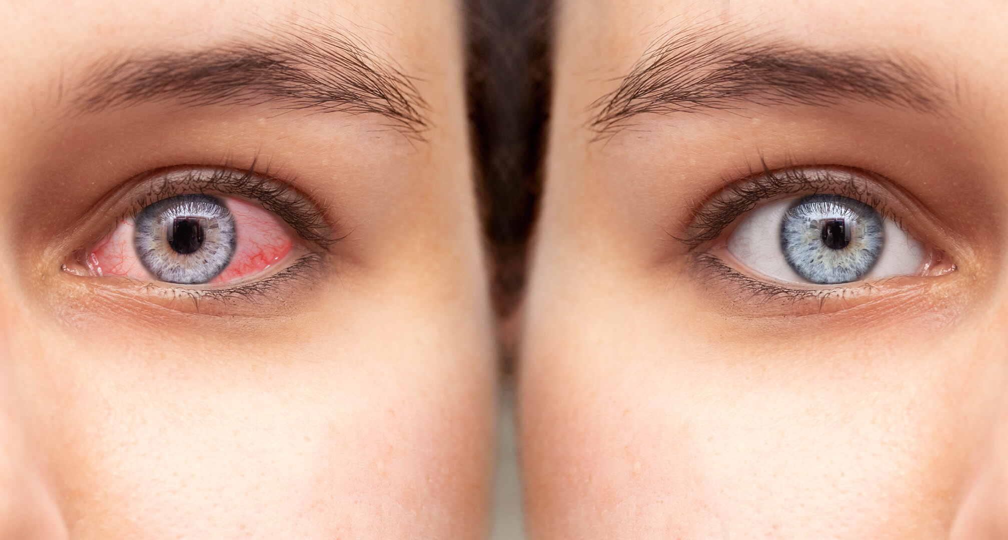 close-up van twee ogen naast elkaar, een rood droog oog links en een gezond oog rechts