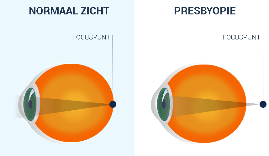 Presbyopie