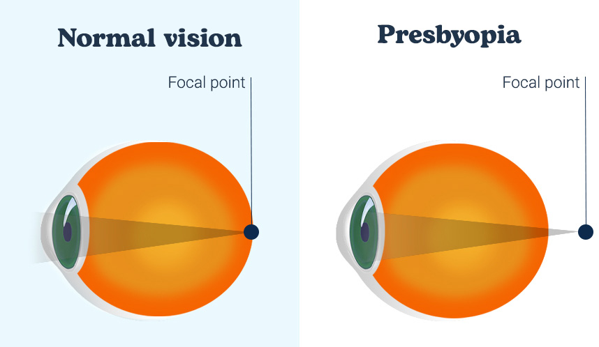 beeld van brandpunt in normaal oog en in oog met presbyopie
