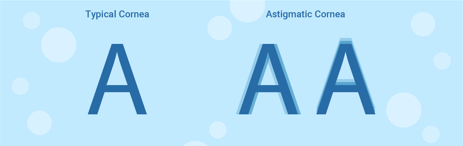 typical and astigmatism cornea