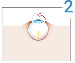 Lasik, stap 2