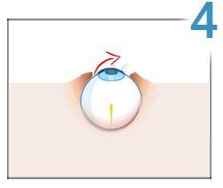 Lasik, stap 4